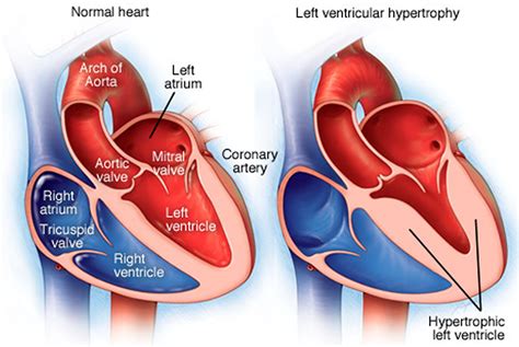 mildly dilated lv|mildly dilated left ventricle.